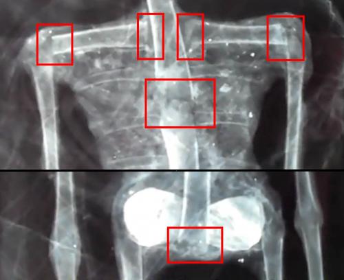 Röntgenbild der angeblichen nur 21 Zentimeter kleinen Alien-Leiche (Bild: YouTube-Screenshot / Bearbeitung: L. A. Fischinger)