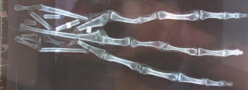 Die "Alien-Hand" aus Peru, Bild 2 - Zur Großansicht anklicken (Bild: YouTube-Screenshot Tyler Cusco)
